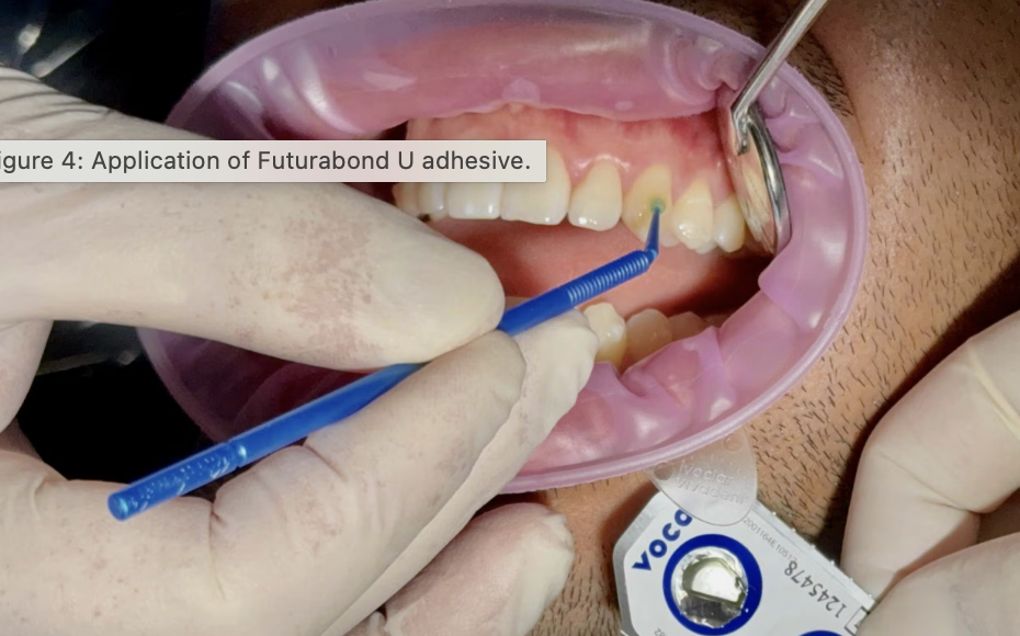 Vì sao attachment quyết định thành công trong điều trị bằng khay trong suốt?